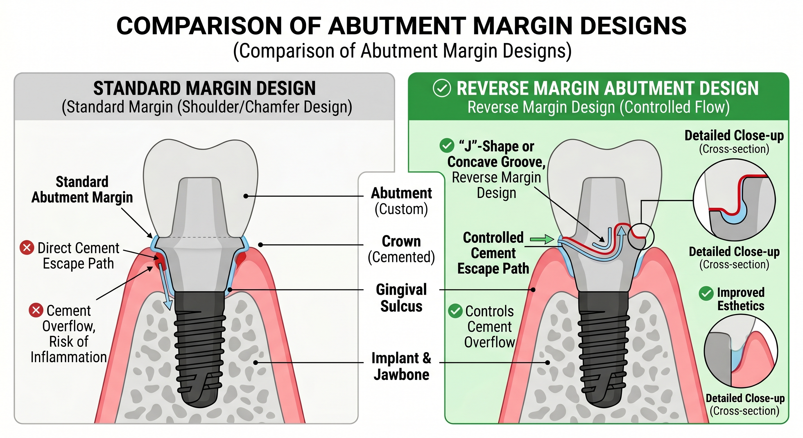 Understanding Reverse Margin Abutments: A Game-Changer for Cement-Retained Restorations