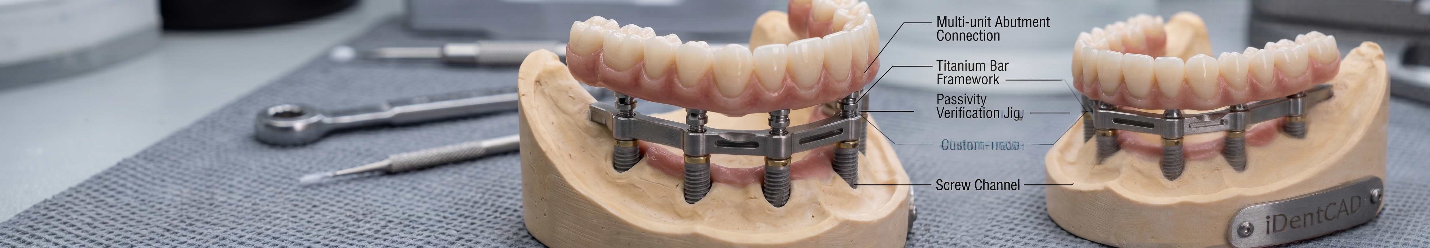 Precision Engineering in Full-Arch Rehabilitation: The iDentCAD All-on-X Workflow