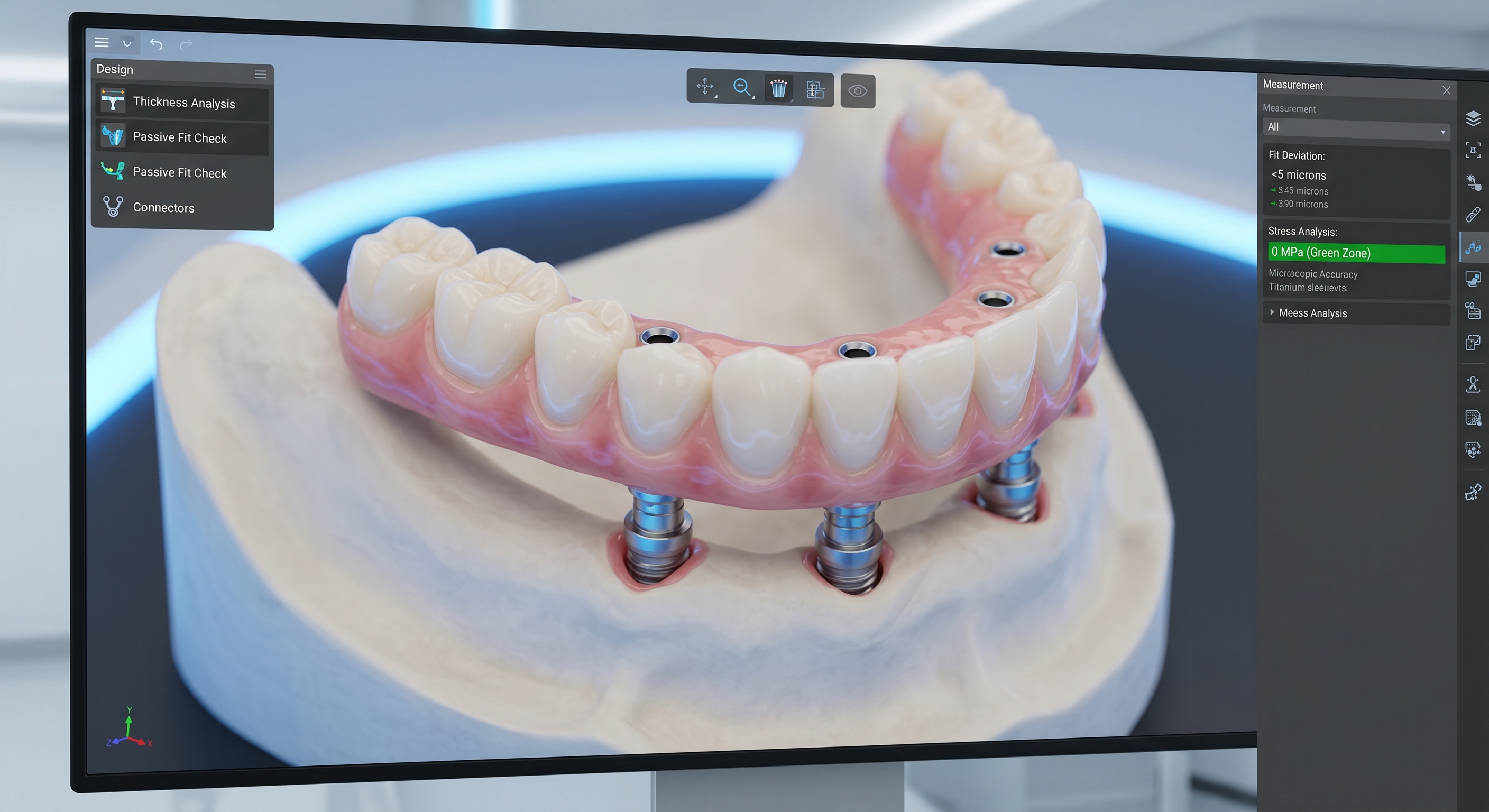 Passive fit vs misfit in full arch implant prosthesis showing stress distribution