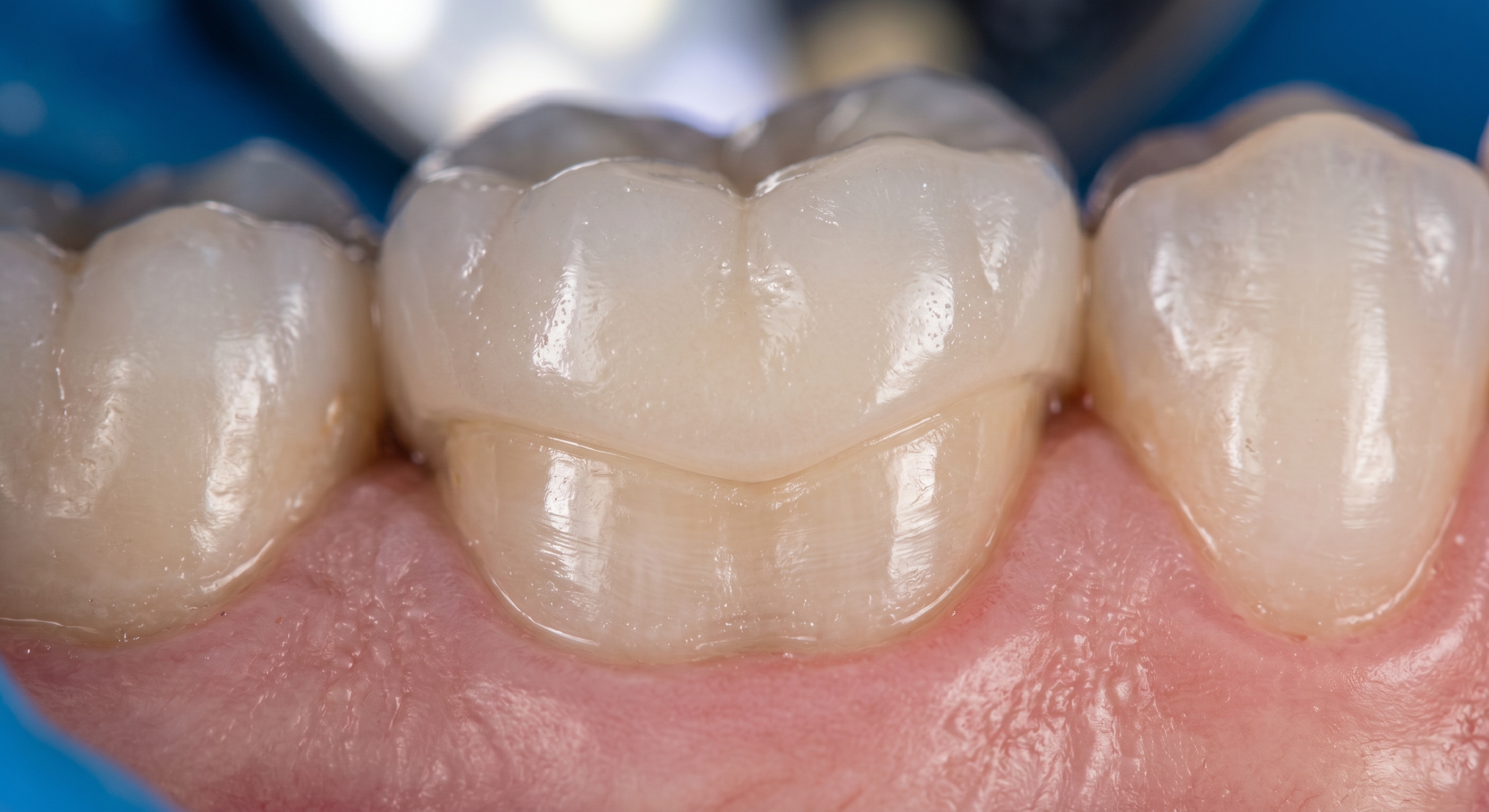 Perfect crown margin adaptation on natural tooth with seamless fit