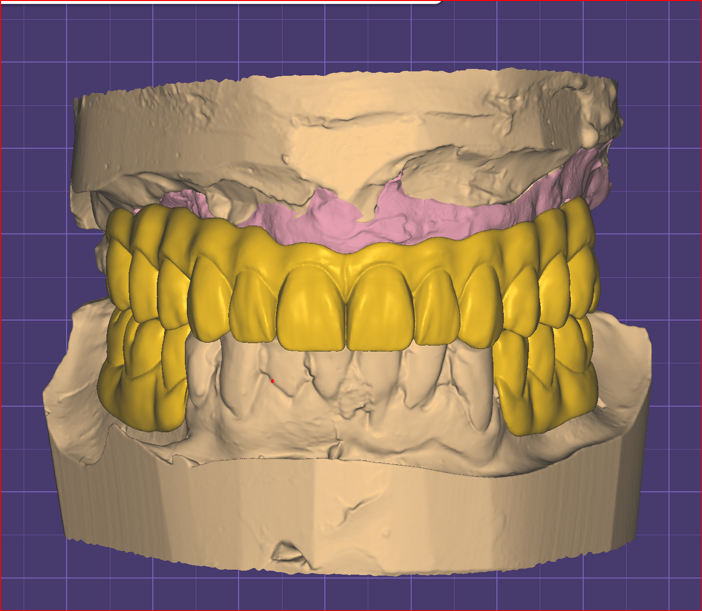 Full arch provisional